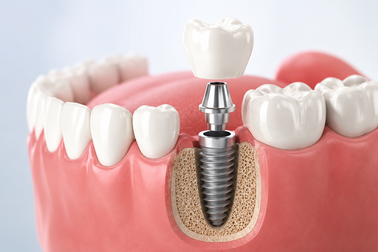 Dental Implants